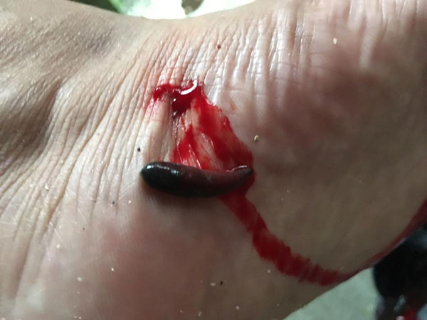 leeches bite